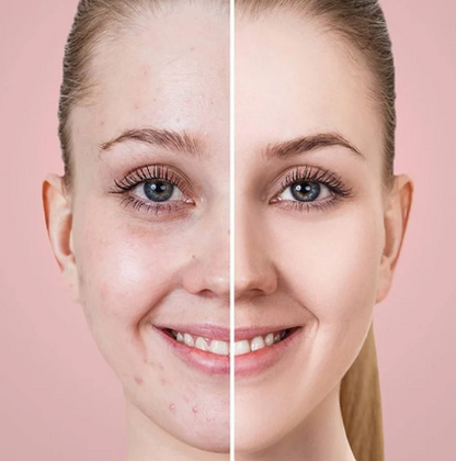 PoreVive – Aspiratore Professionale per Punti Neri